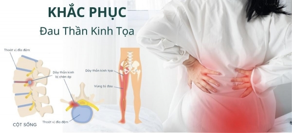 🔻NGUYÊN NHÂN ĐAU THẦN KINH TỌA, LÀM SAO ĐỂ KHẮC PHỤC